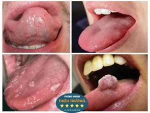 Hình ảnh: Mụn cóc sinh dục ở miệng