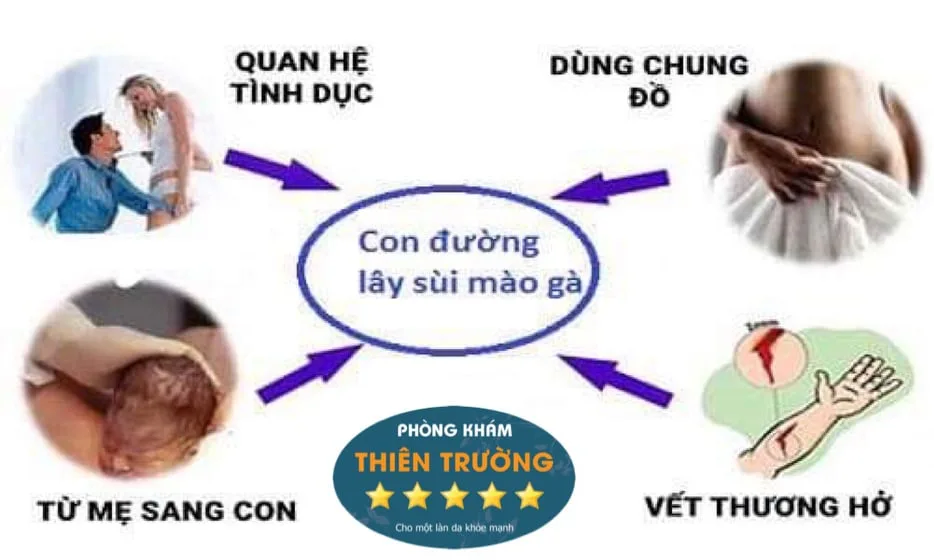 Hình ảnh; Nguyên nhân gây sùi mào gà