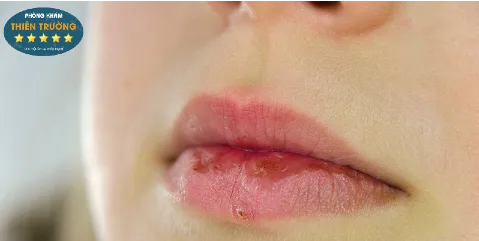 Hình ảnh: Tác hại của thói quen liếm môi