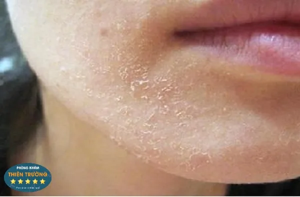 Hình ảnh: Viêm da do tiết bã