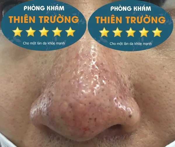 Hình ảnh: Giãn mao mạch ở mũi.