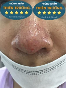 Hình ảnh: Giãn mao mạch