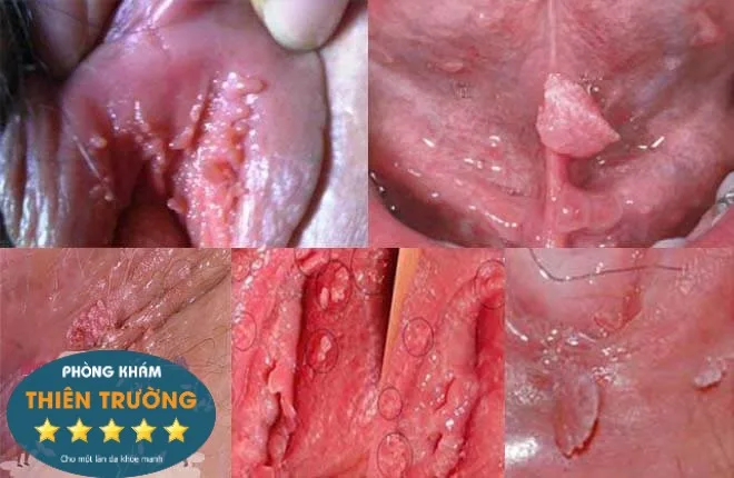 Hình ảnh: Sùi mào gà ở phụ nữ
