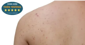 Hình ảnh: Mụn bọc ở lưng.