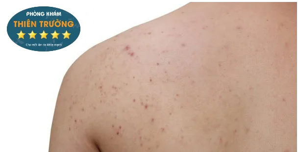 Hình ảnh: Mụn trứng cá ở lưng.