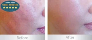 Hình ảnh: trước và sau khi điều trị giãn mao mạch