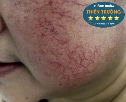 Hình ảnh: Giãn mao mạch