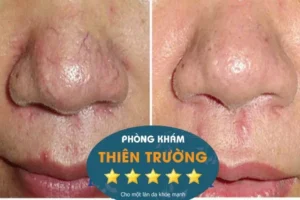 Hình ảnh: Giãn mao mạch