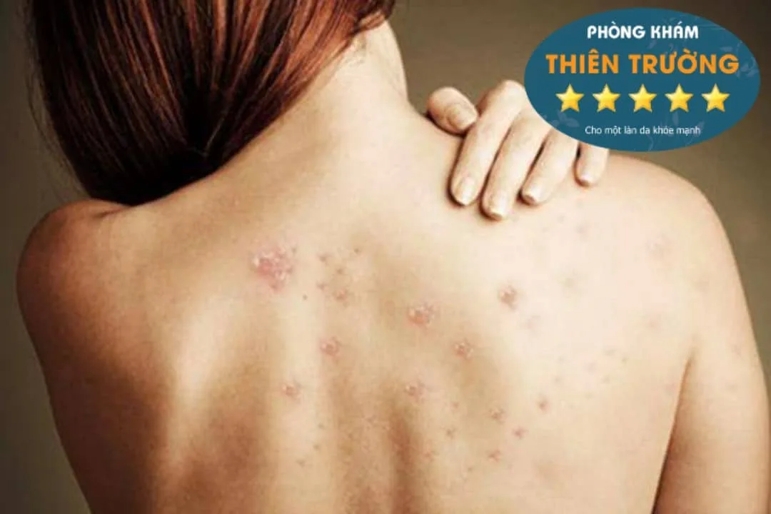 Hình ảnh: Mụn trứng cá ở vai