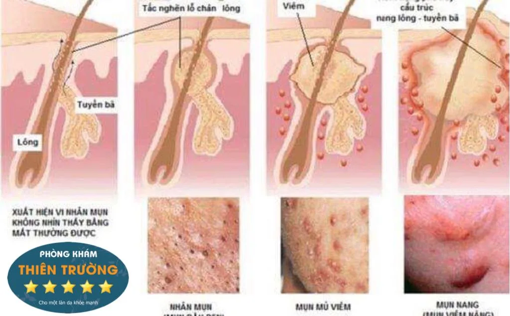 Hình ảnh: Nguyên nhân gây ra mụn trứng cá.