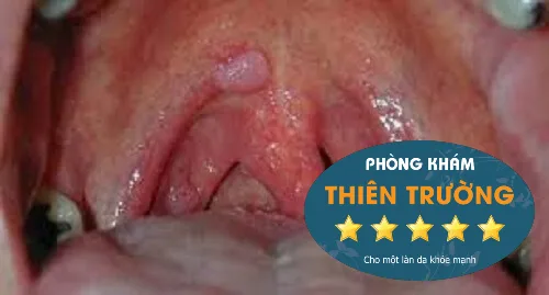 Hình ảnh: Sùi mào gà ở miệng.