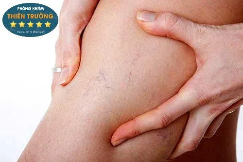 Hình ảnh: Giãn mao mạch ở chân