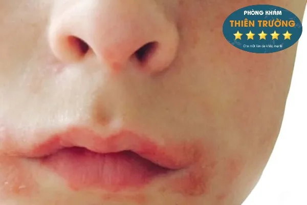 Hình ảnh: Viêm da cơ địa quanh miệng