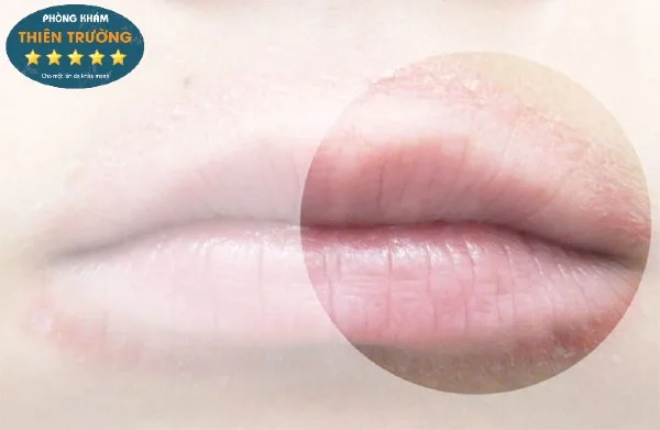 hình ảnh: Viêm da quanh miệng