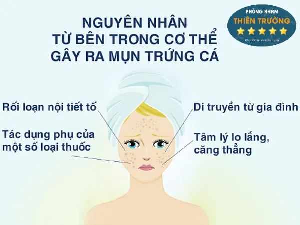 Hình ảnh: Nguyên nhân gây nên mụn trứng cá