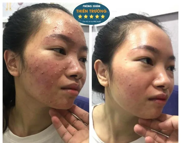 Hình ảnh: Trước và sau khi điều trị mụn