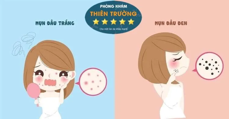 Hình ảnh: Mụn trứng cá