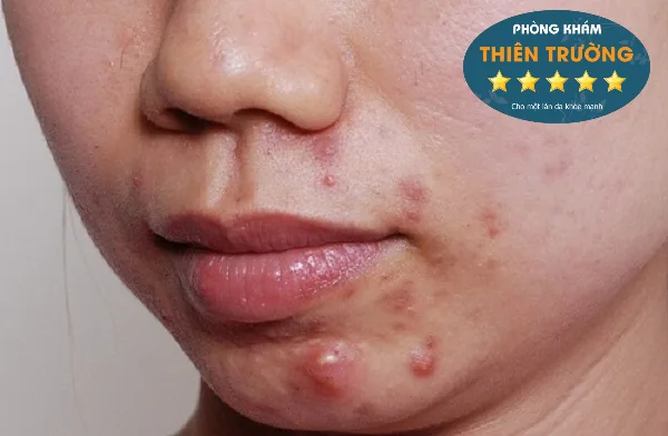 Hình ảnh: Mụn bọc.