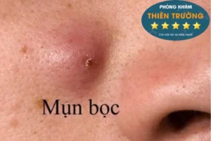 Hình ảnh: Mụn bọc sưng to.