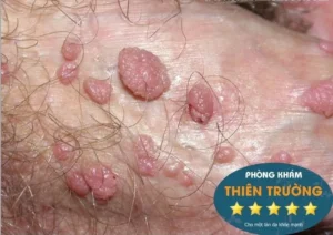 Hình ảnh: Mụn cóc sinh dục