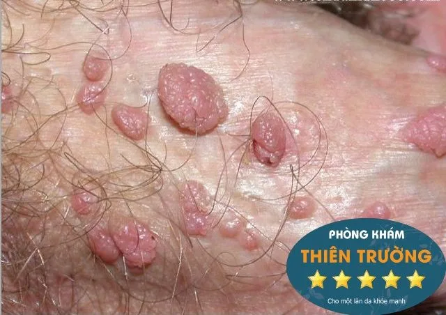 Hình ảnh: Mụn cóc sinh dục