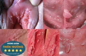 Hình ảnh: Dấu hiệu sùi mào gà.