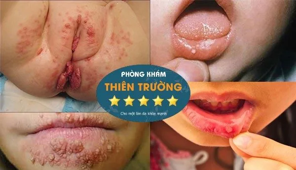 Hình ảnh: Sùi mào gà ở trẻ em