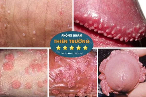 Hình ảnh: Mụn cóc sinh dục