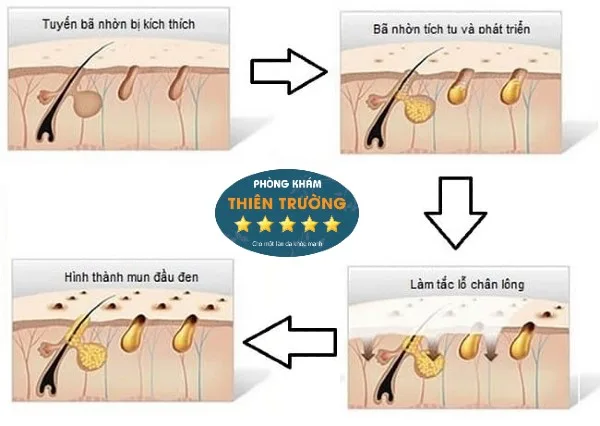 Hình ảnh: Qúa trình hình thành mụn đầu đen