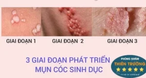 Hình ảnh: Các giai đoạn phát triển của mụn cóc sinh dục.