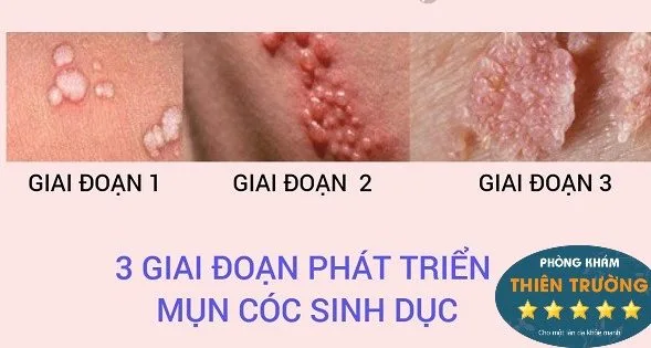 Hình ảnh: Mụn cóc sinh dục