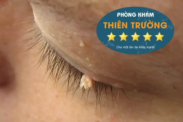 Hình ảnh: Sùi mào gà ở trẻ em