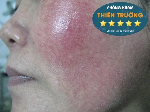 Hình ảnh: Giãn mao mạch do sử dụng corticoid