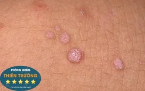 Hình ảnh: Mụn cóc sinh dục