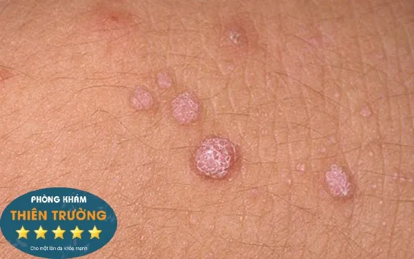 Hình ảnh: Mụn cóc sinh dục