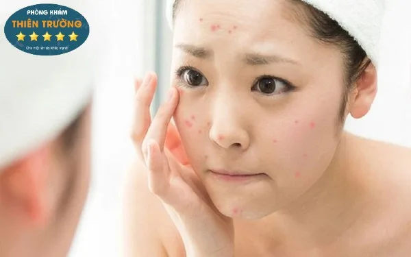 Hình ảnh: Mụn trứng cá