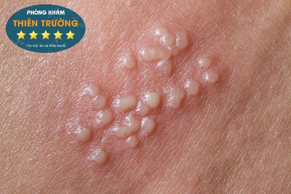 Hình ảnh: Mụn cóc sinh dục