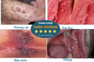 Hình ảnh: Mụn cóc sinh dục