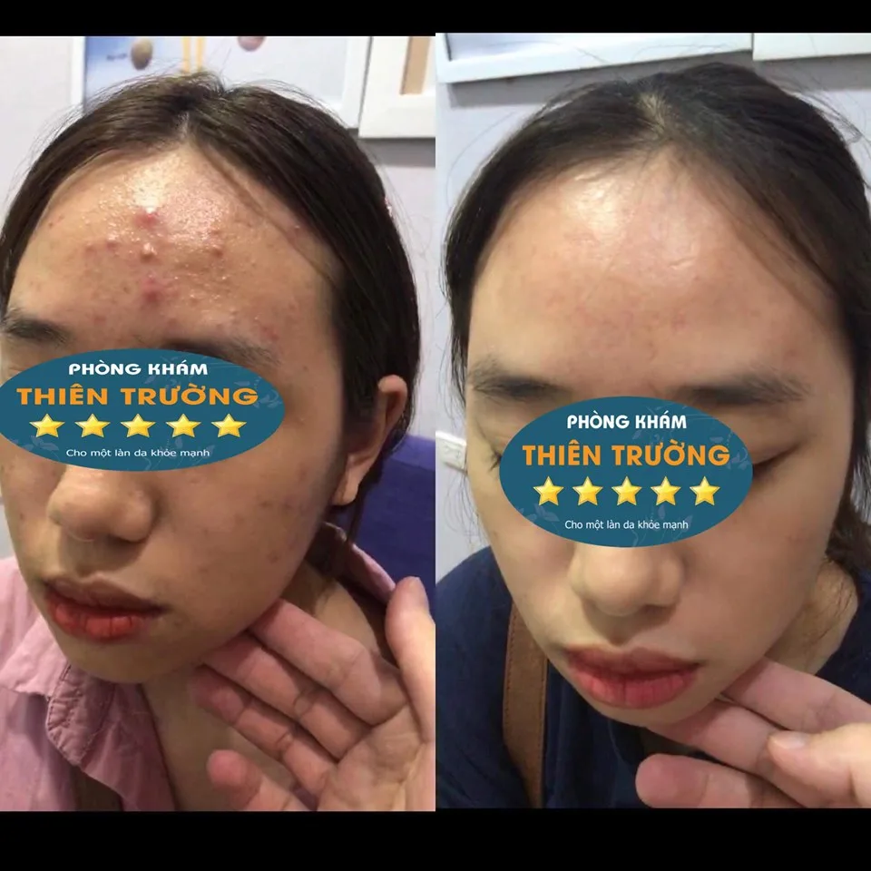 Hình ảnh: trước và sau khi điều trị mụn tại Phòng khám Da liễu Thẩm mỹ Thiên Trường