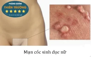 Hình ảnh: Mụn cóc sinh dục ở nữ