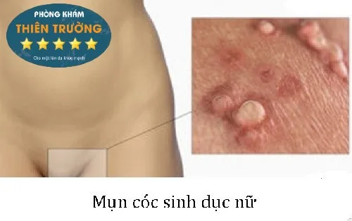 Hình ảnh: Mụn cóc sinh dục ở nữ