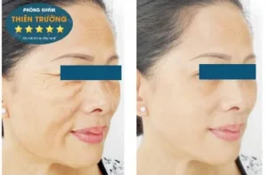 Hình ảnh: Trước sau khi thực hiện căng da tại phòng khám Da liễu-Thẩm mỹ Thiên Trường Nam Định.