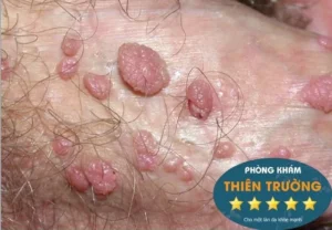 Hình ảnh: Mụn cóc sinh dục