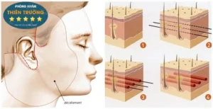 Hình ảnh: Căng da mặt bằng chỉ sinh học