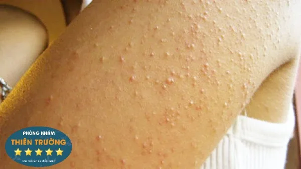 Hình ảnh: Mụn trứng cá ở tay