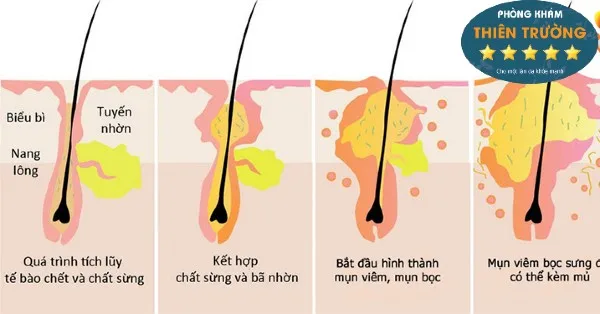 Hình ảnh: Sự hình thành mụn bọc.