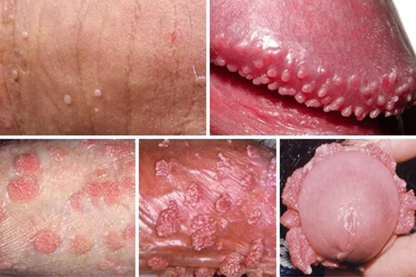 Hình ảnh: Mụn cóc ở bộ phận sinh dục