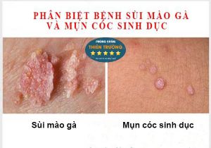 Hình ảnh: Mụn cóc và sùi mào gà