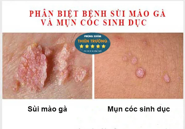 Hình ảnh: Mụn cóc và sùi mào gà