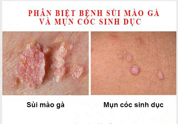 Hình ảnh: Phân biệt bệnh sùi mào gà và mụn cóc sinh dục